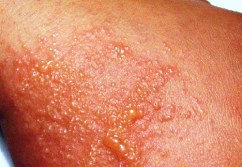 How To Win Your Battle With Eczema?