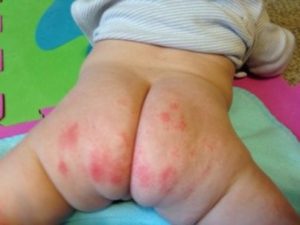 Diaper Rash on Buttocks